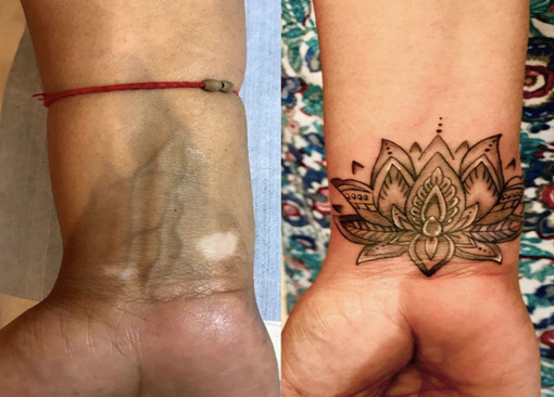 scar-cover-up tattoo